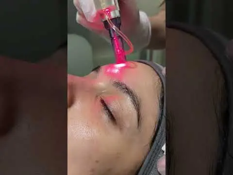 Dermapen en Miriam clinic #dermapen #miriamclinic #belleza