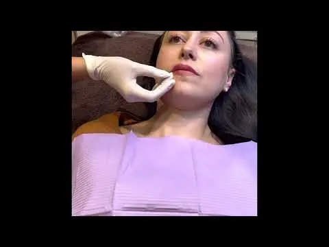 Lip filler in Javea part 2 - Zen Smile Spa
