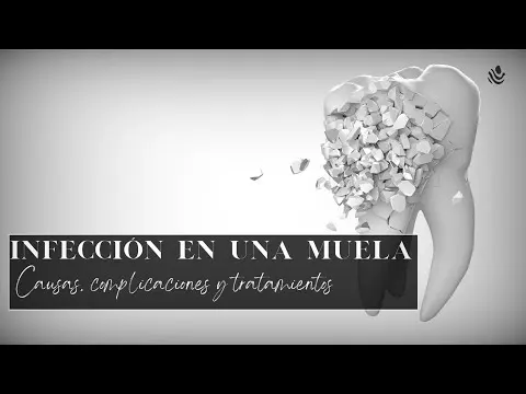 Infección en una muela: Causas, complicaciones y tratamientos