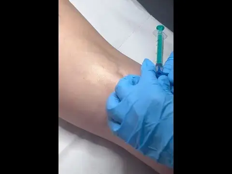 Eliminación de VARICES con Escleroterapia