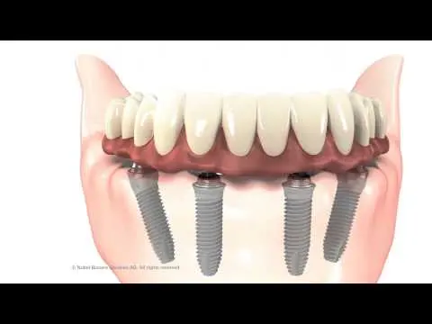 Solucion Allon4 en Santa María Dental. Implantlogía en el Puerto de Santa María