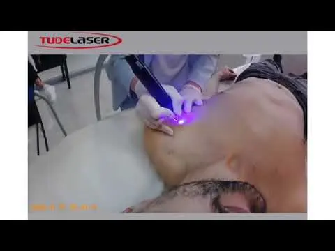 Láser Azul Eliminación de léntigo solar