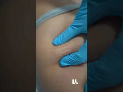 Carboxiterapia: el tratamiento que mejora la circulación y reduce la celulitis #carboxiterapia