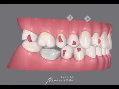 Escaner con Itero - Clinica Dental Madrid - Clinicas Turrion Monescillo