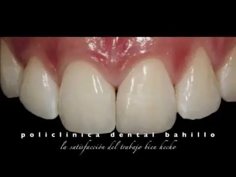 ESTETICA DENTAL EN SANTIAGO DE COMPOSTELA