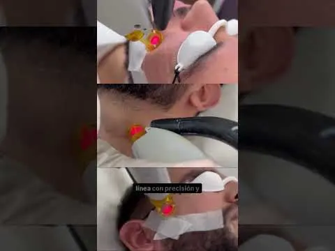 Granitos en la piel que no se van… puede ser foliculitis.   #foliculitis #depilacionlaser