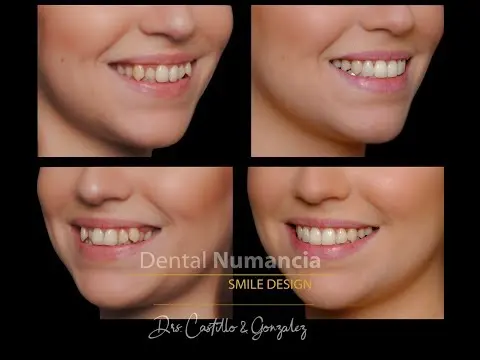 Digital Smile Design aplicado a la ortodoncia invisible