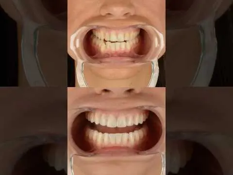 ¿Se puede corregir un apiñamiento complejo sin brackets? Caso real con alineadores