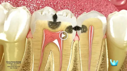 Clinica Dental Dentart Barcelona. Dentista de urgencias, ortodoncia invisible, implantes en el centro de Barcelona.