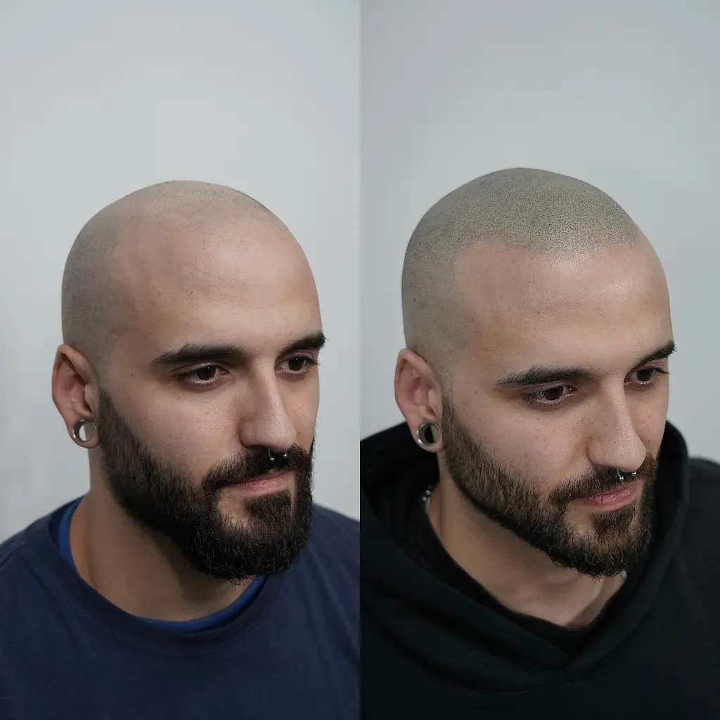 MICROPIGMENTACION CAPILAR EXTREMADURA * Hair Design