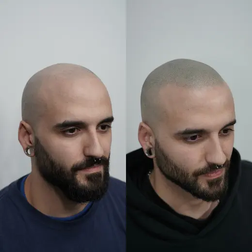 MICROPIGMENTACION CAPILAR EXTREMADURA * Hair Design
